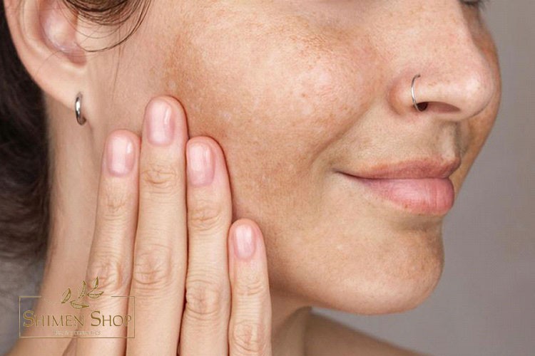 آشنایی با لک پوستی